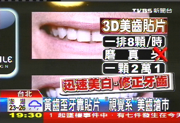 黃齒歪牙靠貼片 「視覺系」美齒搶市