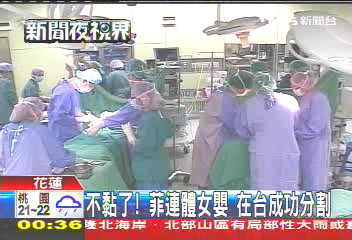 不黏了!菲連體女嬰 在台成功分割