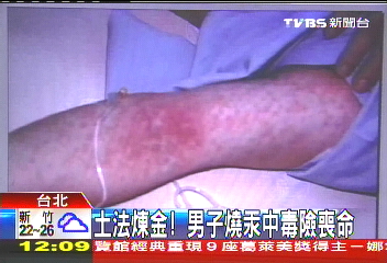 土法煉金! 男子燒汞中毒險喪命
