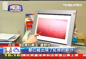 〈獨家〉「瘦」不了!動動椅抖肉 皮膚紅疹發炎