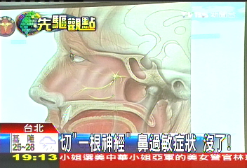 切「一根神經」 鼻過敏症狀沒了!