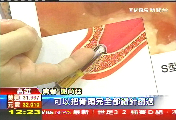榔頭敲齒腦震盪　病患植牙嚇壞！