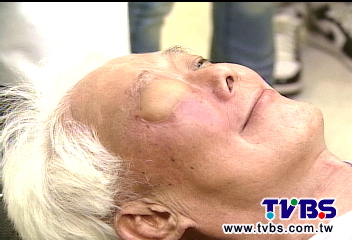 吸菸致眼凸「癌症惹禍」! 罕見摘眼治