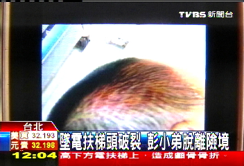男童攀扶梯跌破頭 救回脫離險境