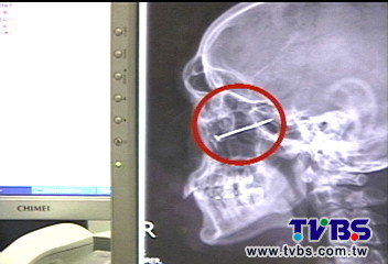 「啪」！釘子回彈穿腦門　差1CM刺中眼球