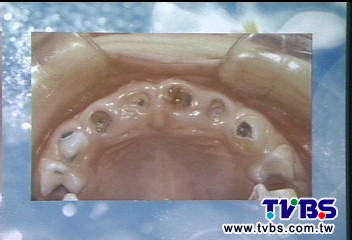 4歲女童蛀16顆牙 引發蜂窩組織炎