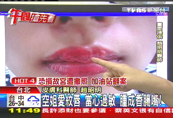 空姐愛紋唇！當心過敏　腫成香腸嘴