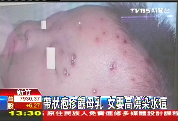帶狀疱疹餵母乳　女嬰高燒染水痘