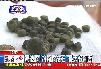 驚破膽！74顆膽結石　最大像葡萄