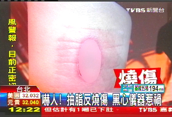 嚇人!抽脂反燒傷 黑心儀器惹禍