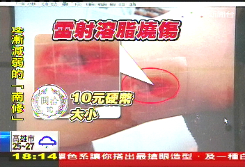 改裝儀器惹禍! 愛美溶脂卻燒破皮