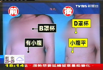 〈獨家〉「30萬脂肪隆乳」稱自然 減肥恐縮水