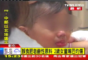 誤食肥皂強鹼原料 1歲女童嘴唇灼傷