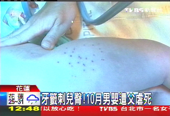 牙籤刺兒臀　親生父涉虐死10月嬰