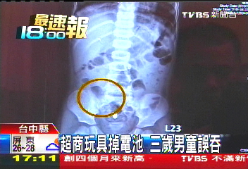 超商玩具掉電池 3歲男童誤吞