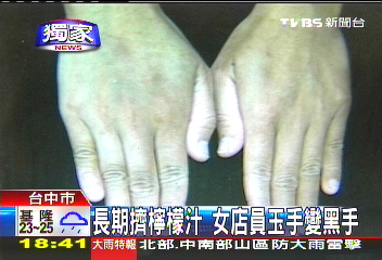 〈獨家〉長期擠檸檬汁　女店員玉手變黑手
