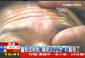 舊制改新制!傷疤少2公分 47萬飛了