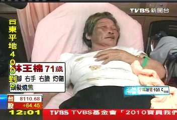 電箱爆！8歲女童臉灼傷　母心疼落淚