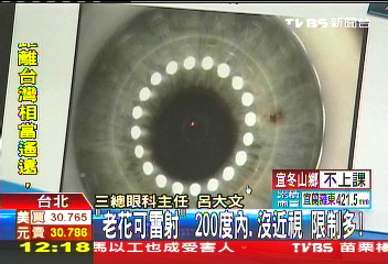「老花可雷射」!200度內、沒近視 限制多