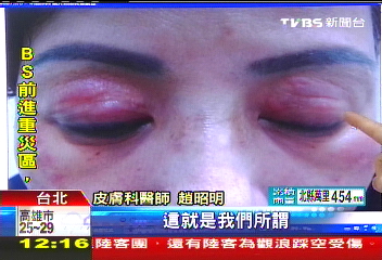 梅姬帶來連日雨 蕁麻疹暴增2成