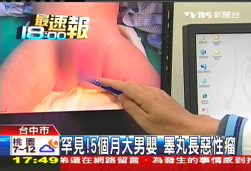 罕見!5個月大男嬰 睪丸長惡性瘤