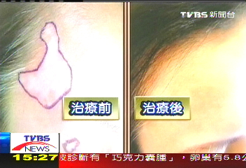 美女冒「白」斑 植「黑」色素挽回自信