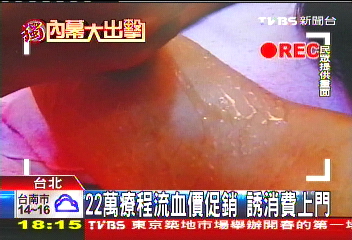 〈獨家〉電波療程瘦2公分? 店員爆料:沒效