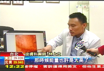 愛美成「斑馬臉」 打脈衝光當心灼傷