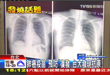 肺癌疫苗「預防」復發　台大發現抗原！