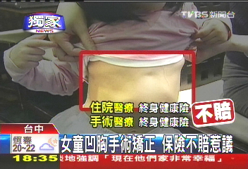 〈獨家〉凹胸不賠有例外 剛生不知情獲賠