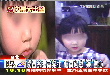 〈獨家〉感冒藥吃成「月亮臉」! 3歲娃疑過敏