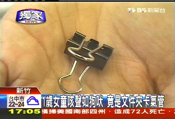 〈獨家〉1歲女童咳聲如狗吠 竟是文件夾卡氣管
