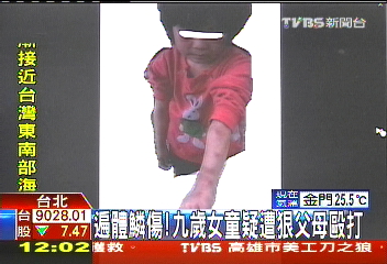 狠父母施暴！　女童遭痛毆遍體鱗傷