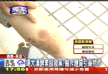 〈獨家〉喝大漢酵素腳發黑? 醫斥體質引藥物疹
