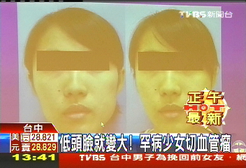 低頭臉就變大! 罕病少女切血管瘤
