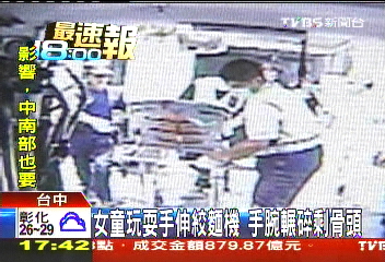 女童玩耍手伸絞麵機 手腕輾碎剩骨頭
