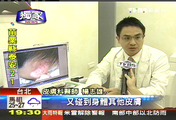 〈獨家〉「面膜沾病毒」　男嘴角皰疹染雙耳！