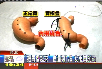 「把胃摺起來」食量剩1/6　女甩肉30KG