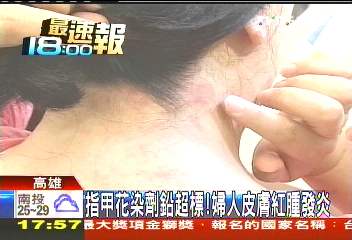 〈獨家〉指甲花染劑鉛超標！　婦人皮膚紅腫發炎