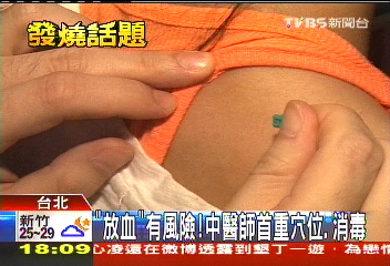 「放血」有風險! 中醫師首重穴位、消毒