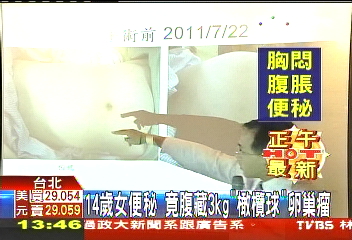 14歲女便秘　竟腹藏3公斤「橄欖球」卵巢瘤