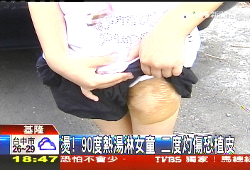 燙！90度熱湯淋女童　二度灼傷恐植皮