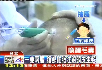 一兼兩顧　腹部抽脂注射頭皮生髮