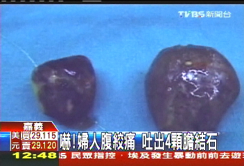嚇!婦人腹絞痛 吐出4顆膽結石
