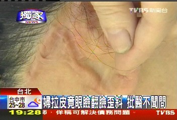 〈獨家〉婦拉皮竟眼瞼翻臉歪斜 批醫不聞問