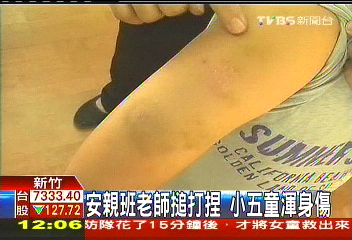 安親班老師搥打捏　小五童渾身傷