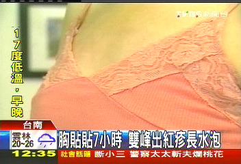 胸貼貼7小時　雙峰出紅疹長水泡