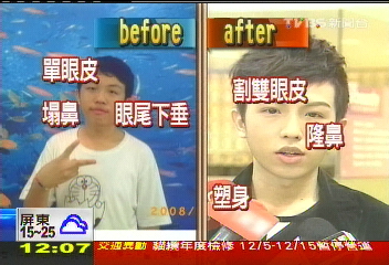 17歲「小眼阿宅」隆鼻　未成年整形惹議