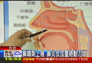 鼻噴劑上癮 鼻炎反加重險動刀除