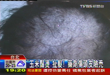 「玉米鬚燙」扯髮！　藥劑傷頭皮險禿